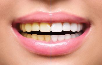 Teeth whitening before / after Johns Creek, GA