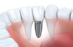 Implant Johns Creek GA