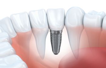 Implant Johns Creek GA, 