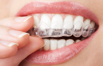woman puts on invisalign close up on lips